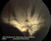 Myelinated nerve fibers superior to the optic disc.